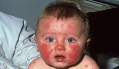 Parvovirüs B19 nedir? Çocuklarda “Beşinci hastalık” nasıl bulaşır? Belirtileri ve tedavisi…