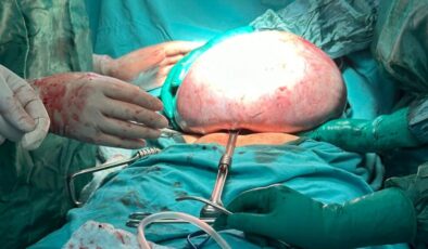 Trabzon’da 83 yaşındaki kadından 10 kiloluk tümör çıkarıldı